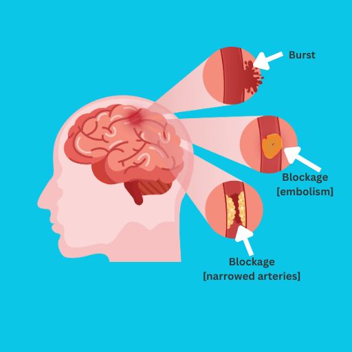 illustration of brain with three types of stroke. One shows burst, one shows a blockage caused by an objecting with text reading embolism, another shows a blockage with narrowed arteries