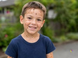 Liam with neurofibromatosis cafe-au-lait spots