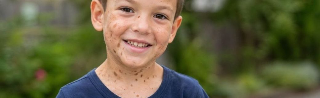 Neurofibromatosis in Children: Signs, Diagnosis and Support